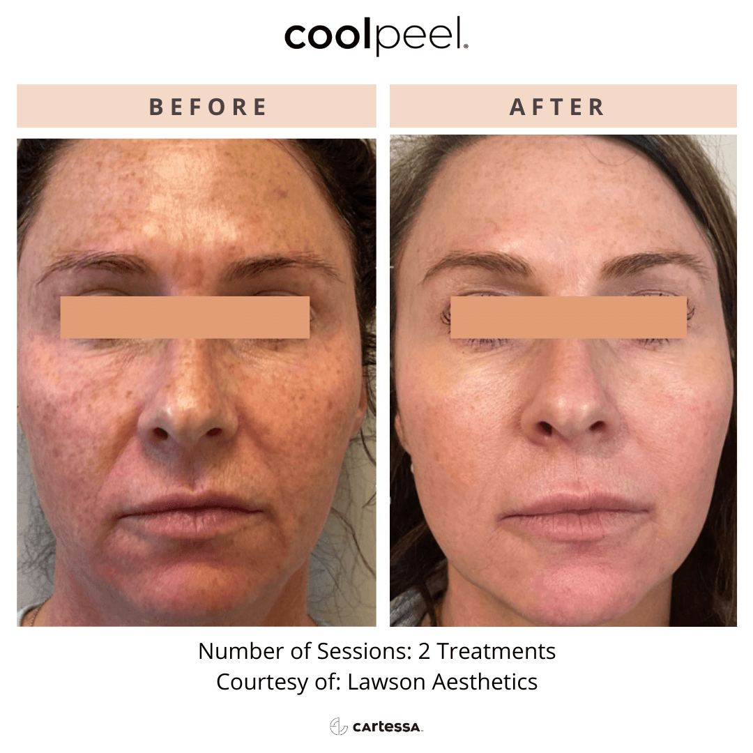 CoolPeel