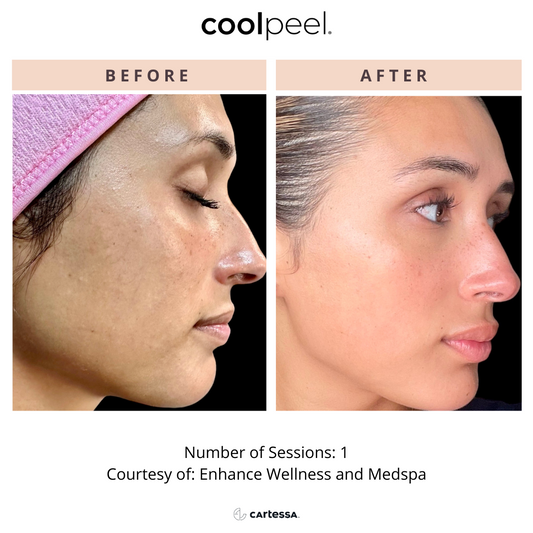 CoolPeel